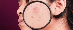 jenis-dan-penanganan-dark-spot-pada-wajah
