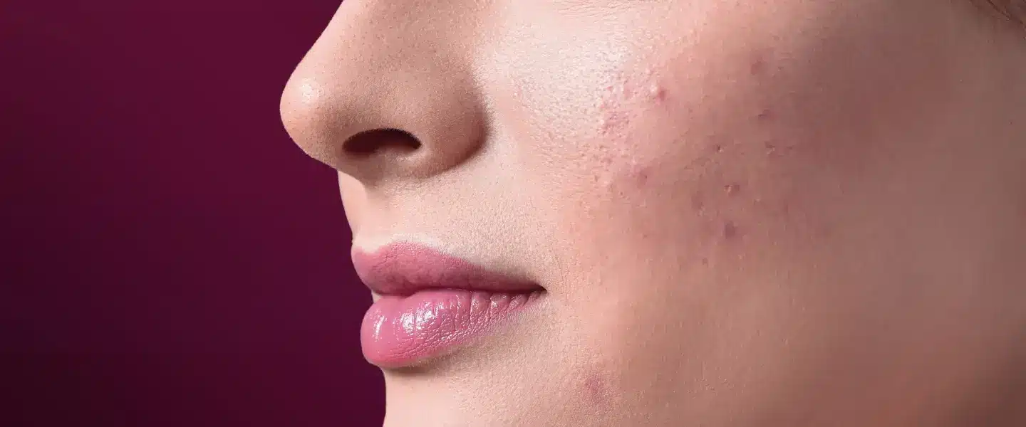 tips-dan-cara-untuk-mengatasi-dark-spot-pada-wajah