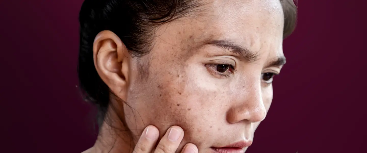 fakta-menarik-dark-spot-yang-jarang-diketahui