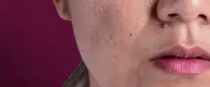 apa-itu-dark-spot-dan-bagaimana-cara-mengatasinya
