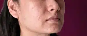apa-sih-artinya-dark-spot-kenali-penyebab-dan-cara-mengatasinya