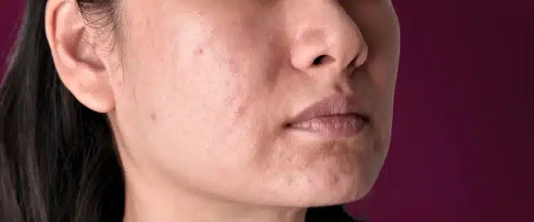 apa-sih-artinya-dark-spot-kenali-penyebab-dan-cara-mengatasinya