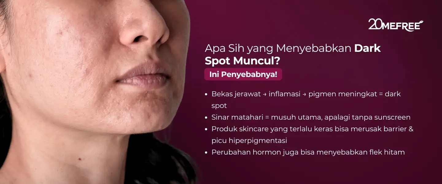 apa-sih-yang-menyebabkan-dark-spot-muncul