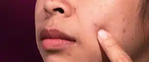 Cara Efektif untuk Atasi Kulit Kusam di Wajah Agar Kembali Segar
