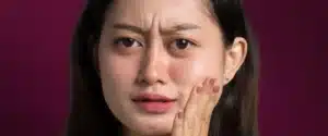 Cara alami dan efektif mengatasi kulit kering di wajah