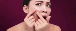 Kulit kering di wajah membuat kita kurang percaya diri