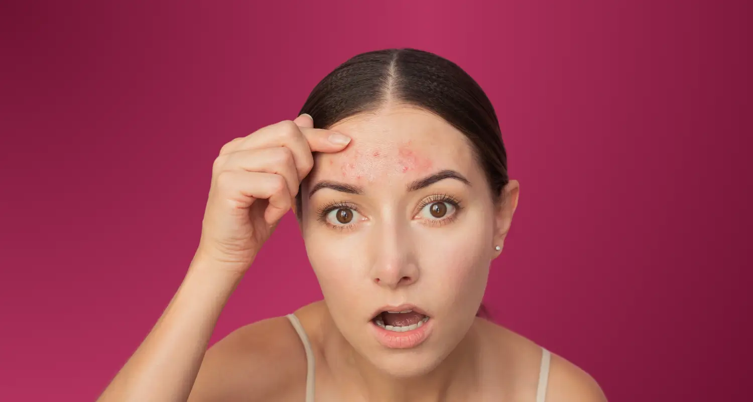 Cara mengatasi purging di wajah dengan cara sederhana dan aman untuk wajah