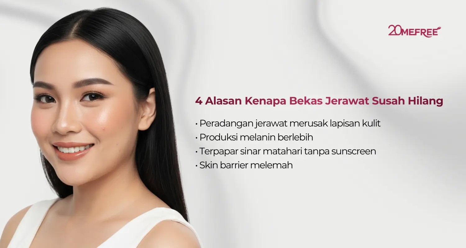 4 Alasan kenapa bekas jerawat susah hilang